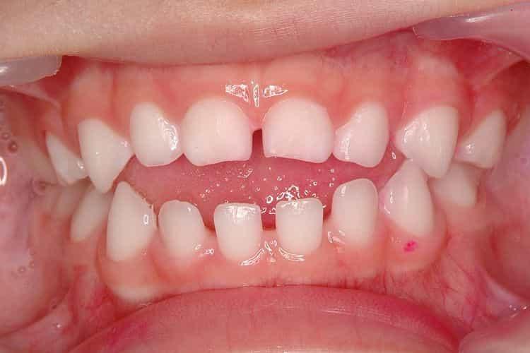 gambar-artikel-1708936235103_jenis kondisi gigi.jpg