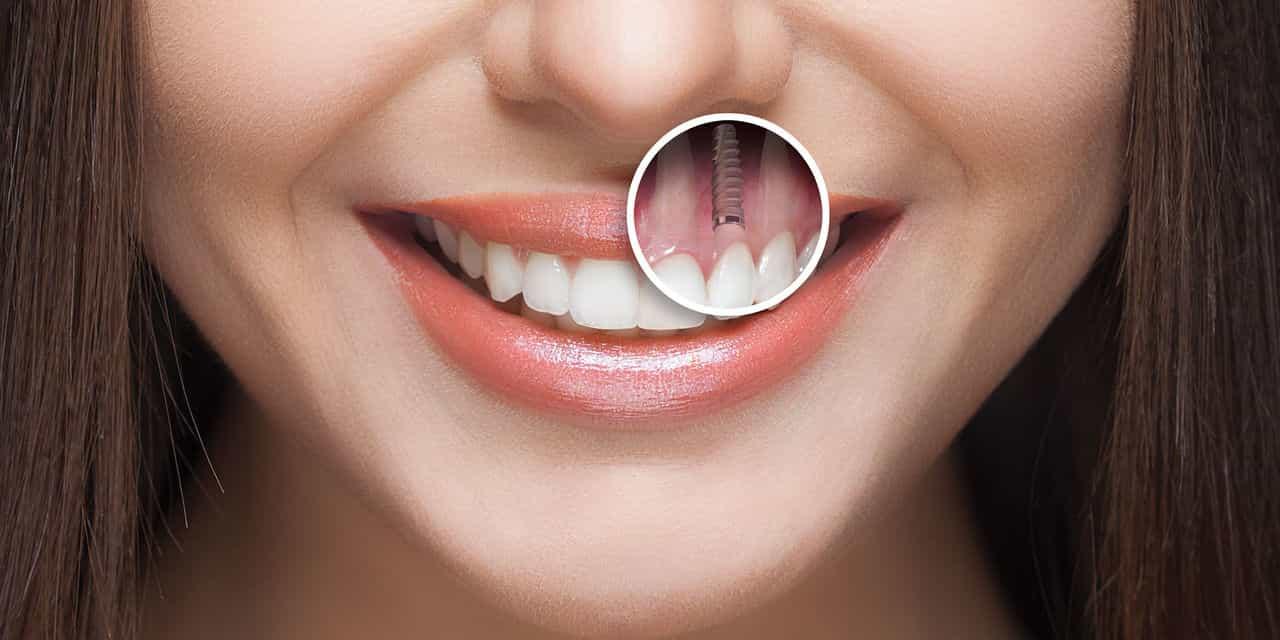 image-gambar-layanan-1712277566351_dental implant.jpeg