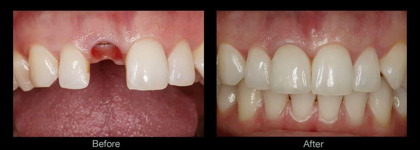 image-gambar-layanan-https://s3-ap-southeast-1.amazonaws.com/public-medicaboo/1712277567135_Dental-Implants-Before-After-Pictures.jpg