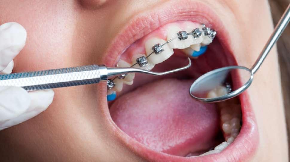 gambar-artikel-1708066151036_proses pemasangan behel gigi.jpg